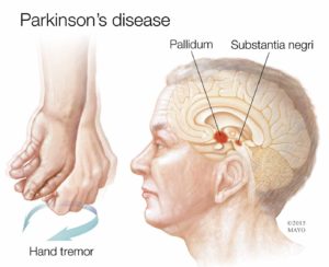 non-traditional-cure-for-Parkinsons-disease