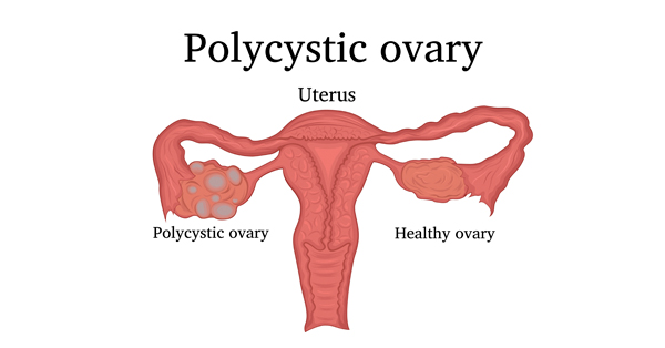 Policystic-ovary-PCOS-Mishin-generator
