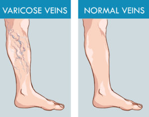 varicose-veins-alternative-medicine